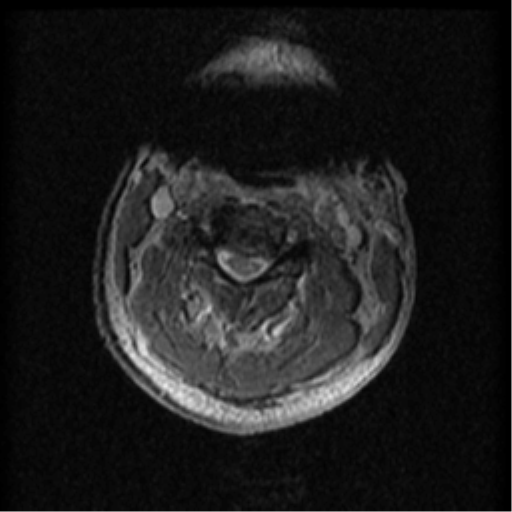 Cervical canal stenosis with cord compression (Radiopaedia 34114-35374 Axial Gradient Echo 67).png