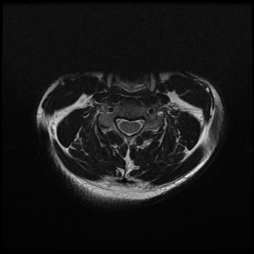 File:Cervical disc extrusion (Radiopaedia 59074-66364 Axial T2 7).jpg