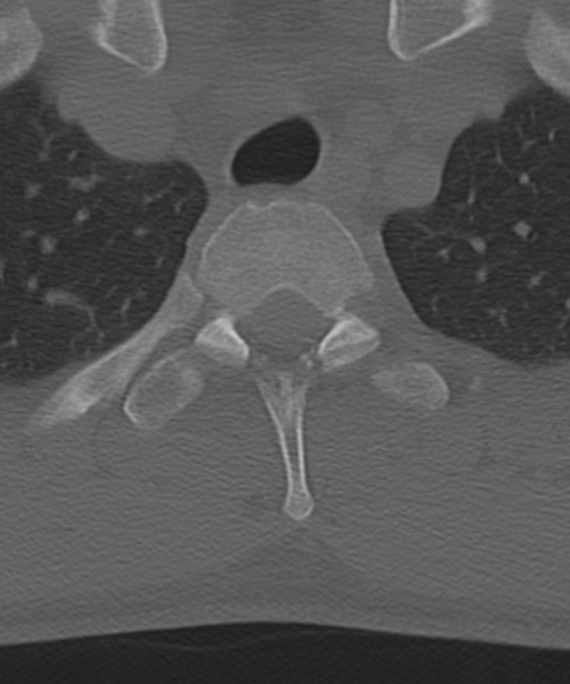 Cervical intercalary bone (Radiopaedia 35211-36748 Axial bone window 69).png