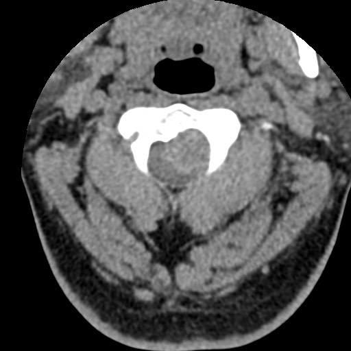 File:Cervical spinal neurofibroma in a patient with NF1 (Radiopaedia 58344-65464 Axial non-contrast 21).jpg