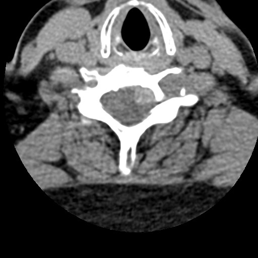 File:Cervical spinal neurofibroma in a patient with NF1 (Radiopaedia 58344-65464 Axial non-contrast 53).jpg