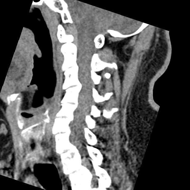 Cervical spinal neurofibroma in a patient with NF1 (Radiopaedia 58344-65464 C 31).jpg