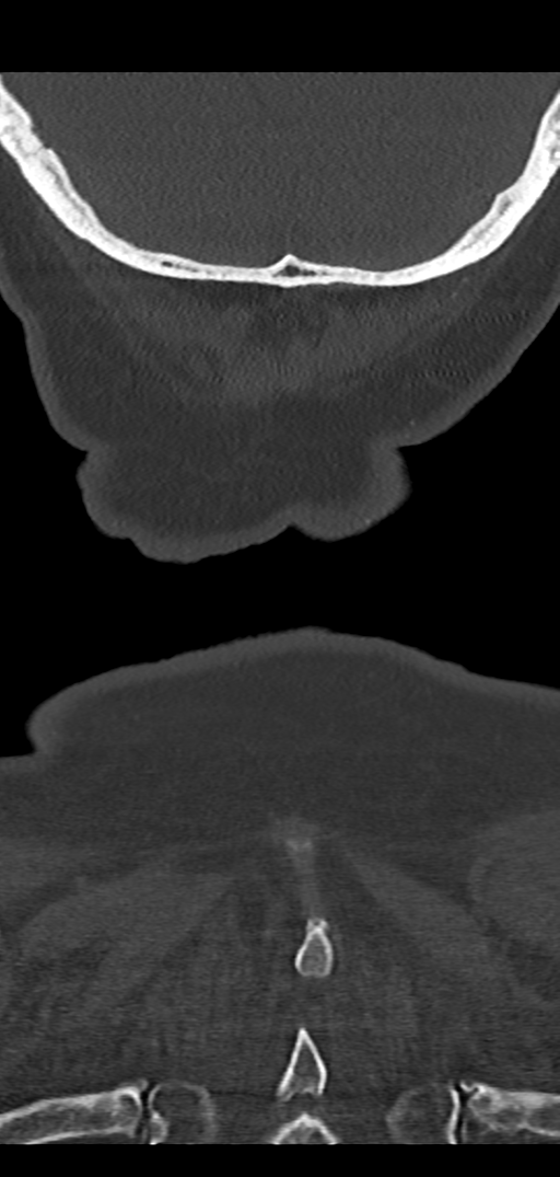 Cervical spine fracture - chalk stick (Radiopaedia 39116-41323 Coronal bone window 54).png