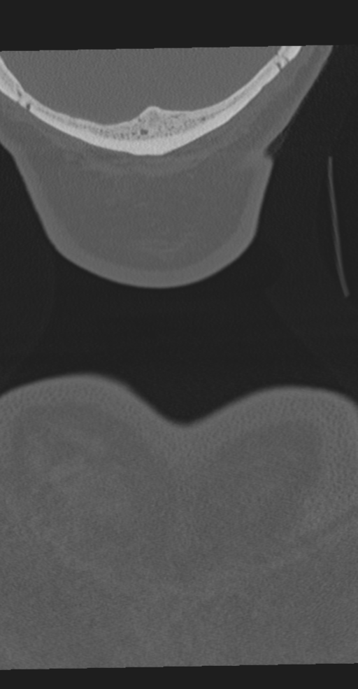 Cervical spine fracture in the setting of ankylosis (Radiopaedia 37038-38715 Coronal bone window 85).png