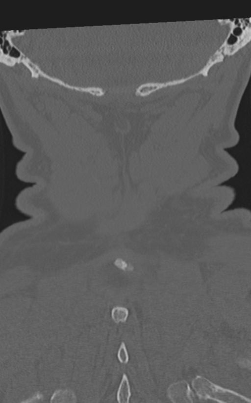Cervical spine fractures with vertebral artery dissection (Radiopaedia 53296-59268 Coronal bone window 63).png