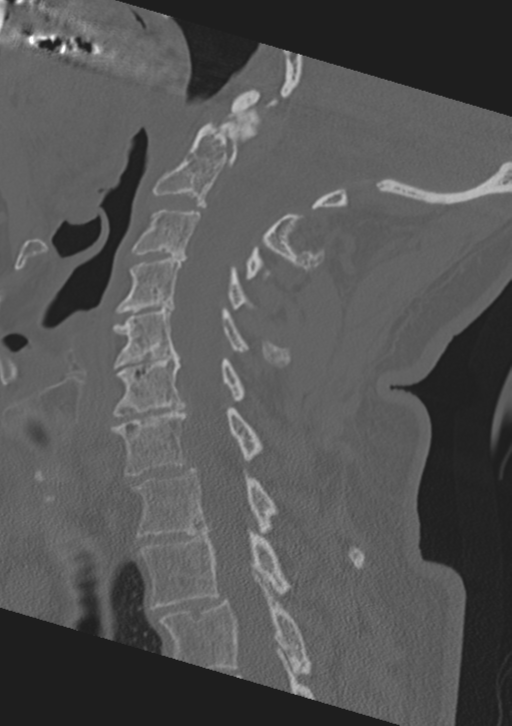 Cervical spine fractures with vertebral artery dissection (Radiopaedia 53296-59268 Sagittal bone window 38).png