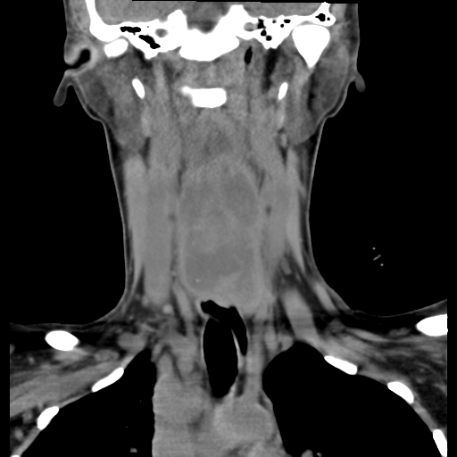 Cervical tuberculous spondylitis (Radiopaedia 39149-41365 Axial non-contrast 1).png