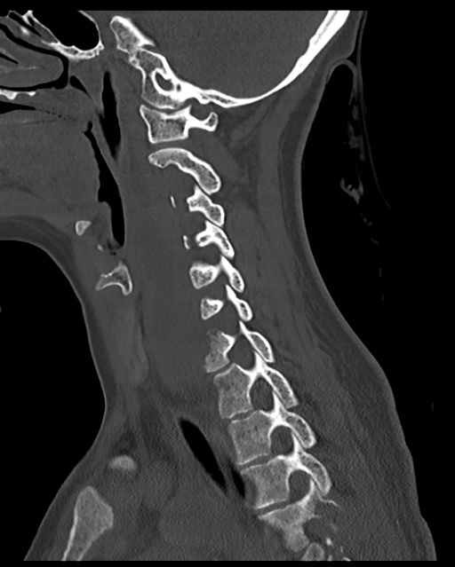 Cervical tuberculous spondylitis (Radiopaedia 39149-41365 Sagittal bone window 27).png