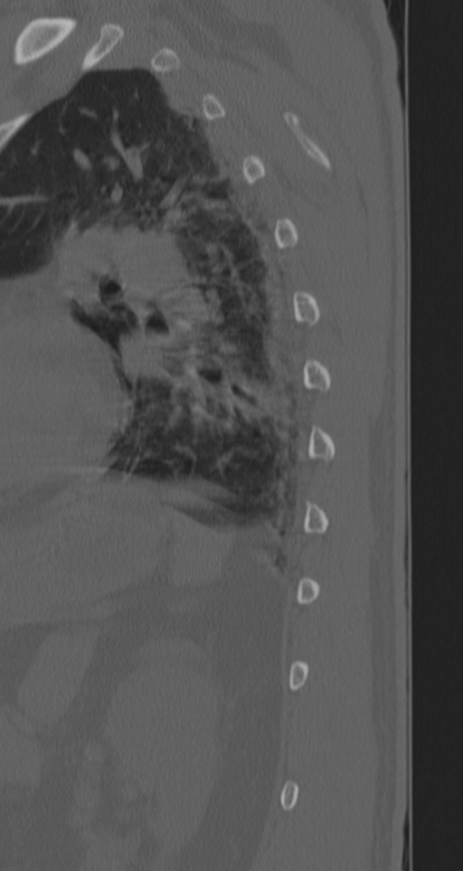 Chance fracture (Radiopaedia 33854-35020 Sagittal bone window 13).png