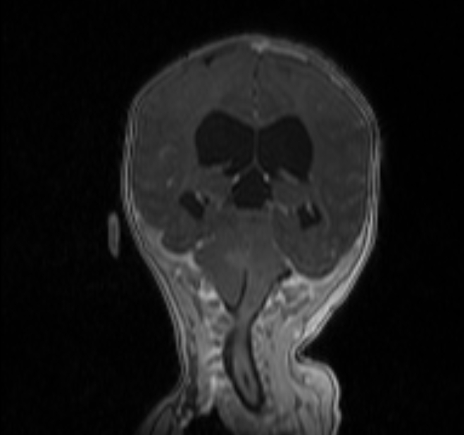 Chiari III malformation with occipital encephalocele (Radiopaedia 79446-92559 Coronal T1 C+ mpr 24).jpg