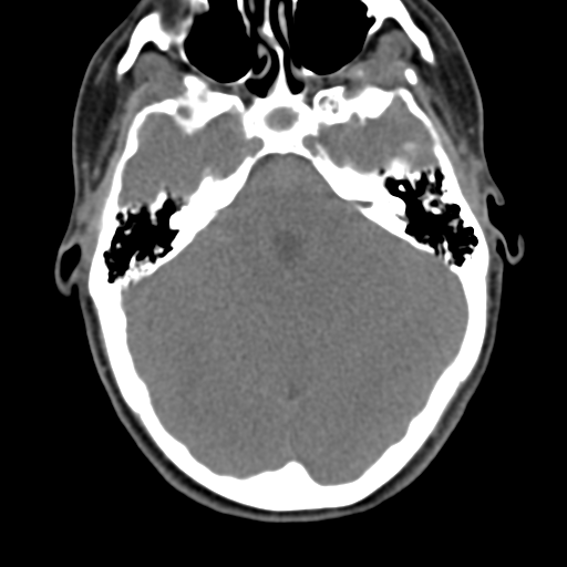 File:Chiari I malformation and obstructive hydrocephalus (Radiopaedia 41185-43981 D 21).png