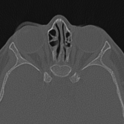 Choanal atresia (Radiopaedia 88525-105975 Axial bone window 85).jpg