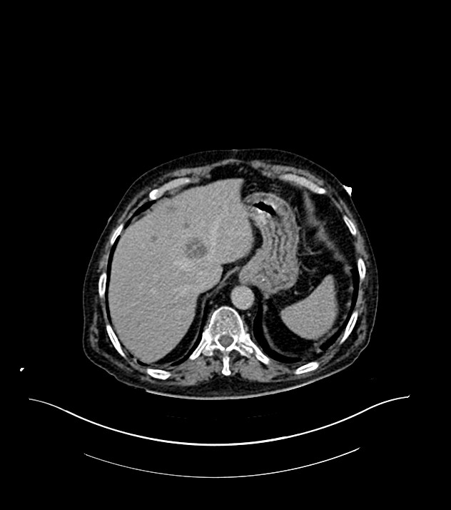 Cholangiocarcinoma with cerebral metastases (Radiopaedia 83519-98629 Axial C+ delayed 17).jpg