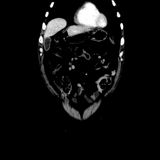 Choledocholiathiasis with normal caliber common bile duct (Radiopaedia 75368-86632 Coronal liver window 33).jpg