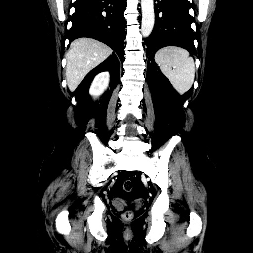 Choledocholiathiasis with normal caliber common bile duct (Radiopaedia 75368-86632 Coronal liver window 90).jpg