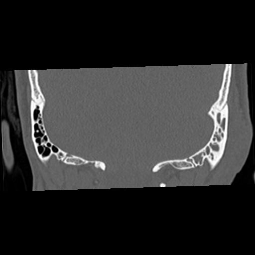 Cholesteatoma (Radiopaedia 84960-100474 Coronal bone window 56).jpg