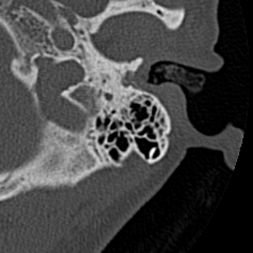 File:Cholesteatoma of the external ear (Radiopaedia 16540-16225 Axial bone window 29).jpg
