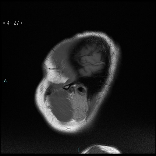 File:Cholesterol granuloma of the petrous apex (Radiopaedia 64358-73140 Sagittal T1 27).jpg