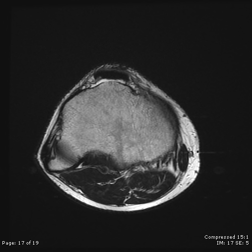 File:Chondroblastoma (Radiopaedia 25725-25891 Axial T2 17).jpg