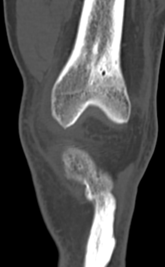 Chondrocalcinosis (Radiopaedia 82862-97173 Coronal bone window 23).jpg