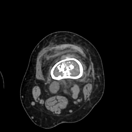 Chondrosarcoma - femur (Radiopaedia 64187-72954 Axial non-contrast 29).jpg