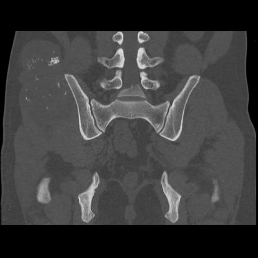 Chondrosarcoma of iliac wing (Radiopaedia 63861-72599 Coronal bone window 77).jpg
