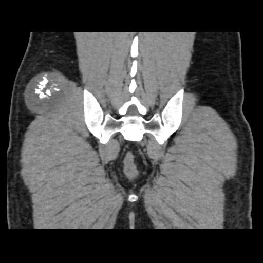 File:Chondrosarcoma of iliac wing (Radiopaedia 63861-72599 Coronal non-contrast 93).jpg