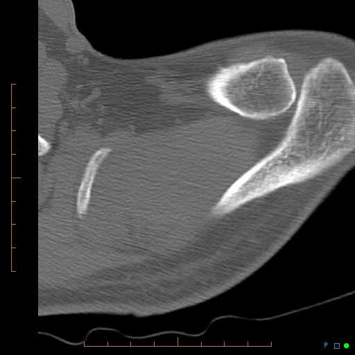 File:Chondrosarcoma of the scapula (Radiopaedia 30696-31399 Axial non-contrast 18).jpg