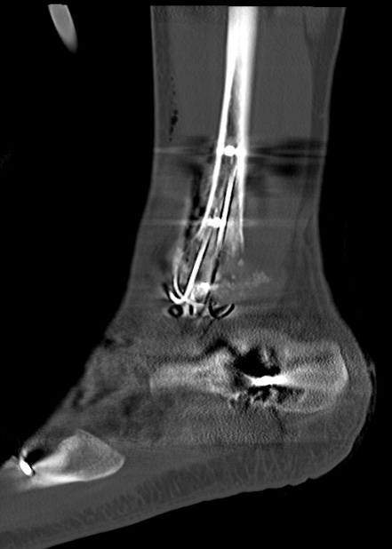 Chopart fracture (Radiopaedia 35347-36861 Sagittal bone window 56).jpg