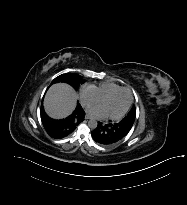 Chromophobe renal cell carcinoma (Radiopaedia 84239-99519 Axial non-contrast 17).jpg