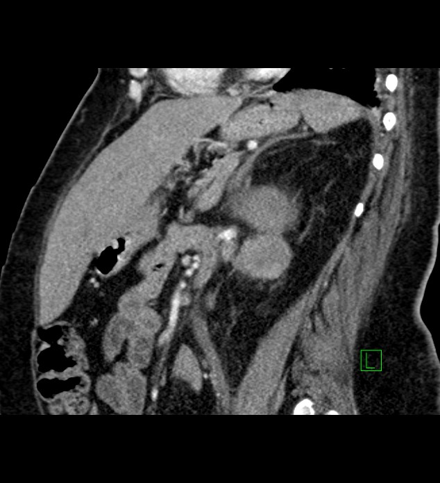 Chromophobe renal cell carcinoma (Radiopaedia 84239-99519 D 49).jpg