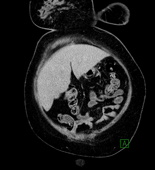Chromophobe renal cell carcinoma (Radiopaedia 84239-99519 F 17).jpg
