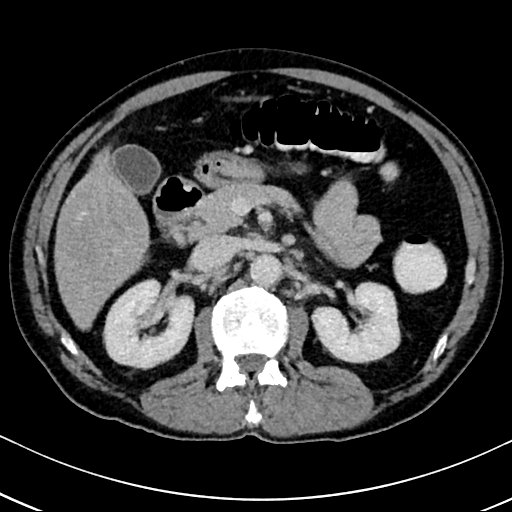 Chronic appendicitis complicated by appendicular abscess, pylephlebitis and liver abscess (Radiopaedia 54483-60700 B 61).jpg
