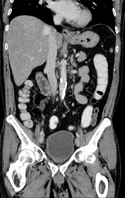 Chronic appendicitis complicated by appendicular abscess, pylephlebitis and liver abscess (Radiopaedia 54483-60700 C 41).jpg
