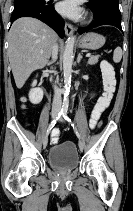 Chronic appendicitis complicated by appendicular abscess, pylephlebitis and liver abscess (Radiopaedia 54483-60700 C 45).jpg