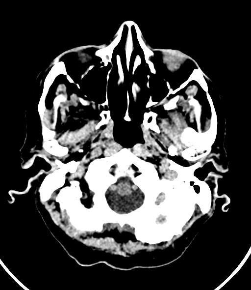 Chronic bilateral subdural hygroma (Radiopaedia 85801-101623 Axial non-contrast 53).jpg