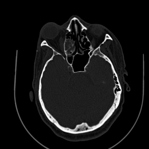 Chronic invasive fungal sinusitis (Radiopaedia 91563-109286 Axial sinus 72).jpg