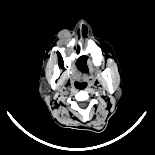 File:Chronic invasive fungal sinusitis with intraorbital and intracranial extension (Radiopaedia 56387-63046 Axial non-contrast 32).jpg