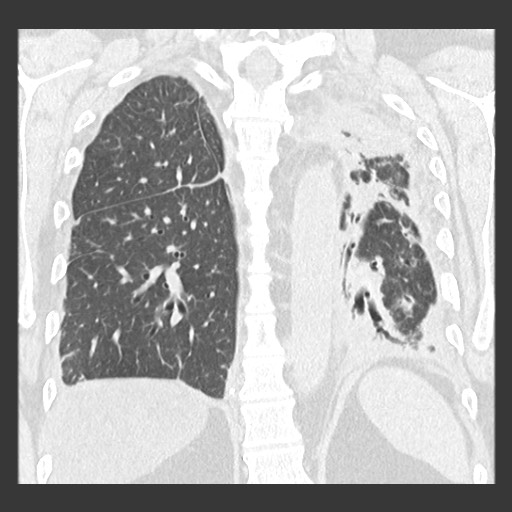 Chronic lung allograft dysfunction - restrictive form (Radiopaedia 60595-68316 Coronal lung window 70).jpg