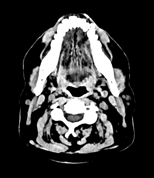 File:Chronic osteomyelitis - calvarial (severe) (Radiopaedia 69668-79616 Axial 135).jpg