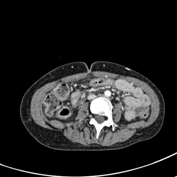 File:Chronic pancreatitis (Radiopaedia 55405-61846 A 57).jpg