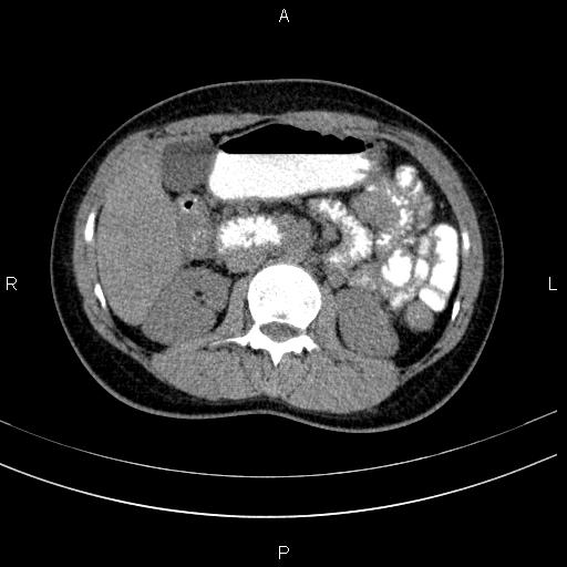 Chronic pancreatitis (Radiopaedia 64576-73450 Axial non-contrast 65).jpg
