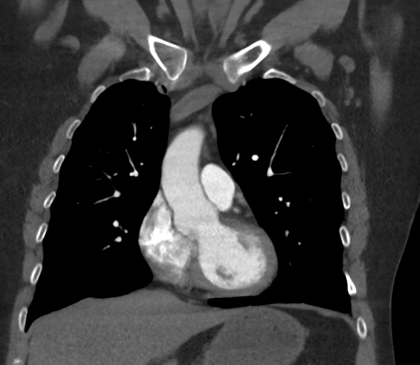 Chronic pulmonary embolus (Radiopaedia 39129-41341 Coronal C+ CTPA 35).png