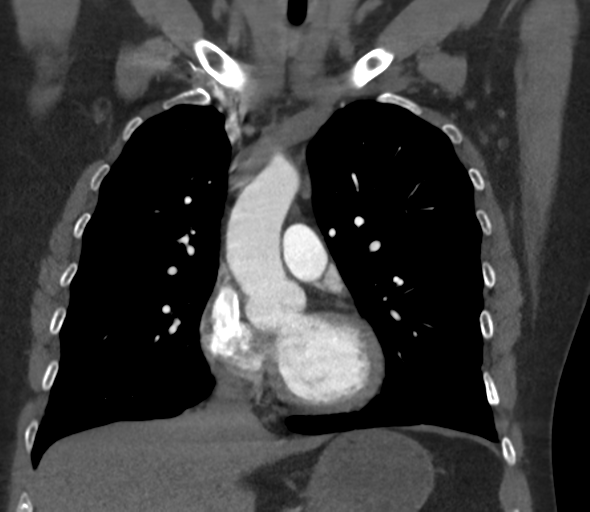 Chronic pulmonary embolus (Radiopaedia 39129-41341 Coronal C+ CTPA 37).png