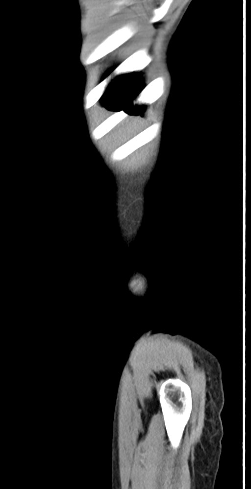 Chronic small bowel volvulus (Radiopaedia 75224-86322 C 136).jpg