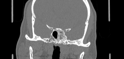 File:Chronic sphenoidal sinusitis (Radiopaedia 62030-70122 Coronal bone window 123).jpg