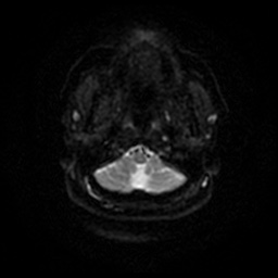 Chronic submandibular sialadenitis (Radiopaedia 61852-69885 Axial DWI 37).jpg