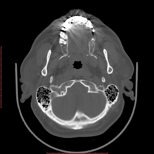 Chronic submandibular sialolithiasis (Radiopaedia 69817-79814 Axial bone window 7).jpg