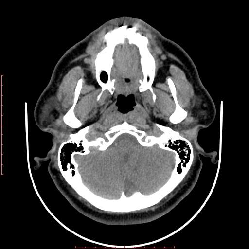 Chronic submandibular sialolithiasis (Radiopaedia 69817-79814 Axial non-contrast 29).jpg