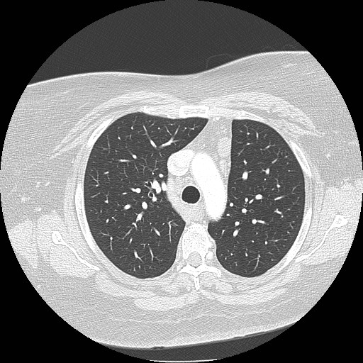 Cicatrisation collapse (Radiopaedia 17405-17089 lung window 37).jpg